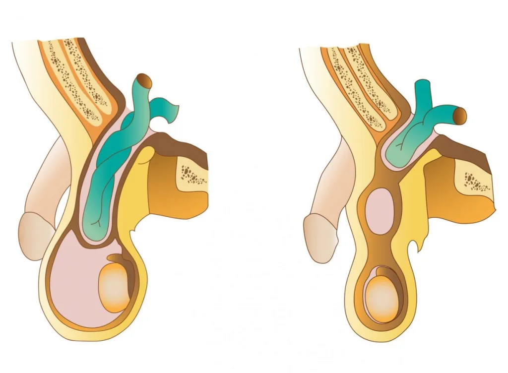 Que hacer despues de una operación de hernia inguinal