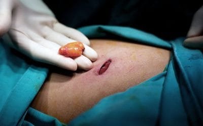 Todo sobre la Recuperación y Cuidados Postoperatorios de la Cirugía de Lipoma