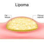 Lipoma Madrid