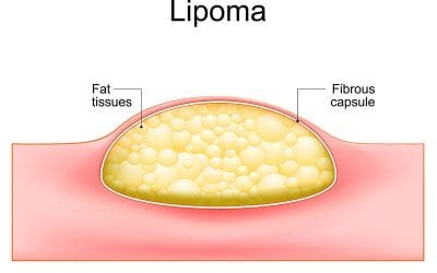 Diferencias entre Lipomas y Otros Tipos de Bultos